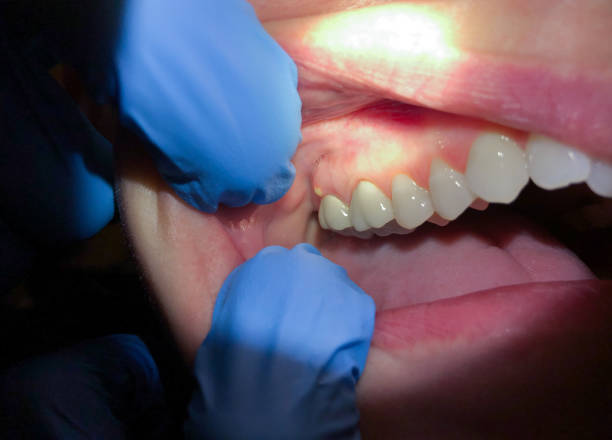 Best Emergency Wisdom Teeth Removal in Munfordville, KY